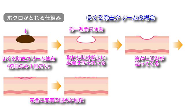 ほくろ除去クリームでほくろ除去経過