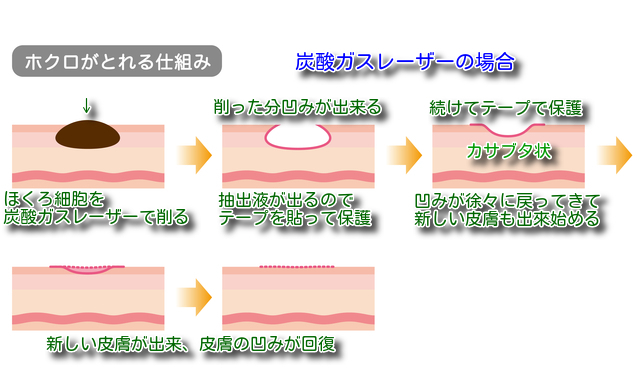 炭酸ガスレーザーでほくろ除去経過