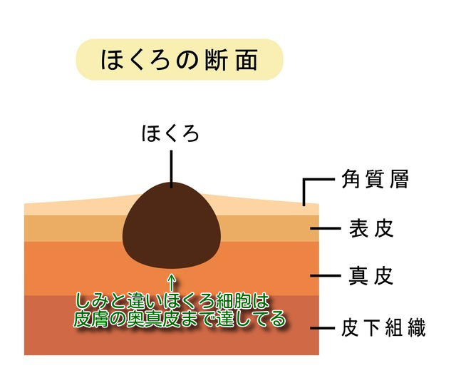 ほくろの断面図