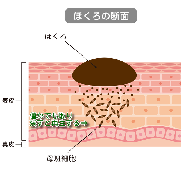 ほくろの再発原因