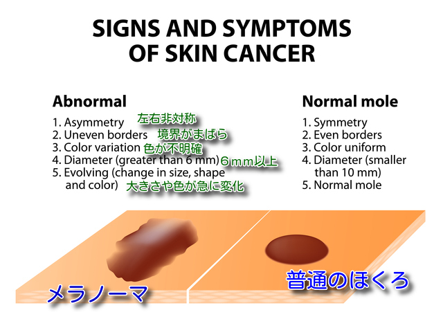 メラノーマと普通のほくろの違い