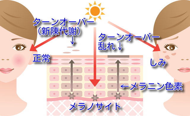 シミが出来る原因