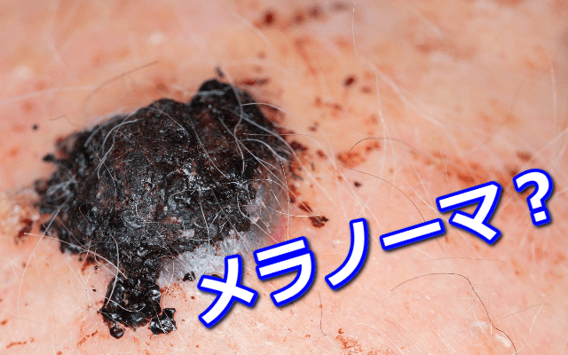 足の裏のほくろがメラノーマ？悪性黒色腫とは？