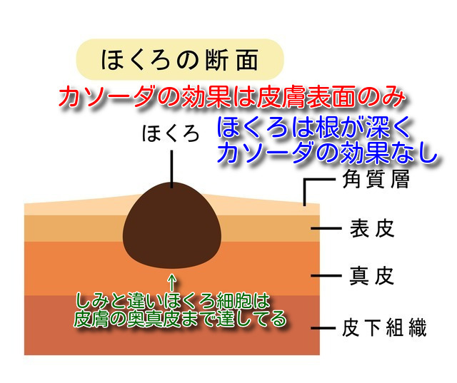 カソーダはほくろには効果なし